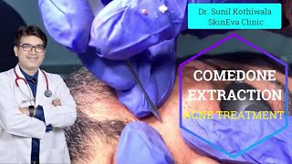 Comedone Extraction Procedure Video  Dermatologist  Comedone Extraction in Jaipur [upl. by Eri362]