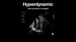 Hyperdynamic Left Ventricle Apical [upl. by Edmead245]