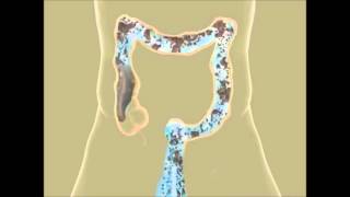 Colon Hydrotherapy in Pune  Constipation Treatment  Piles Treatment  Detox  Colon Cleansing IBS [upl. by Anilorac]