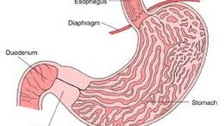 Pyloric Stenosis [upl. by Olwena]