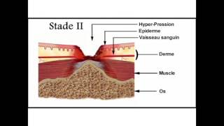 Soins des escarres en gériatrie  2Physiopathologie de lescarre [upl. by Sellihca]