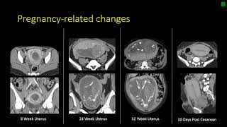 Gynecologic Radiology Anatomy [upl. by Rahm]