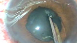 Lysis of Synechiae and Cataract Surgery  Tips amp Tricks [upl. by Adaline]