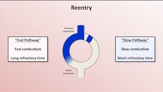 AV node reentry tachycardia atrial activation with 3D mapping [upl. by Flam]