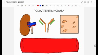 POLYARTERITIS NODOSA [upl. by Favianus322]