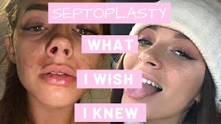 How To Survive A Septoplasty  What I Wish I Knew [upl. by Yolande971]