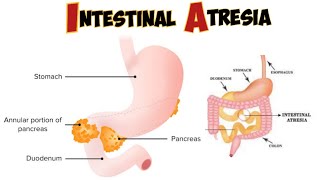 Intestinal atresia amp stenosis [upl. by Rains]