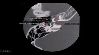 TOMOGRAFIA COMPUTADA DE OIDO PEÑASCO Y CONDUCTO AUDITIVO [upl. by Debora]