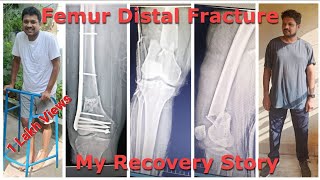 Distal Femur Fracture Recovery Part  1 [upl. by Cullie]