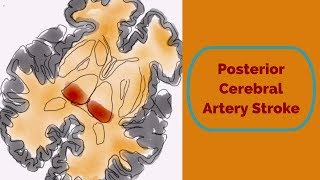 Posterior Cerebral Artery Stroke [upl. by Edny]