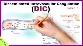 DIC Disseminated Intravascular Coagulation  Part 1 [upl. by Faso600]