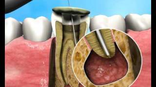 Treatment of Apical Periodontitis  a new approach [upl. by Aker]