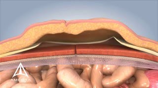 Ventral Hernia Repair  3D Medical Animation [upl. by Ripleigh]