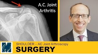 Life After Knee Arthroscopy [upl. by Landon]