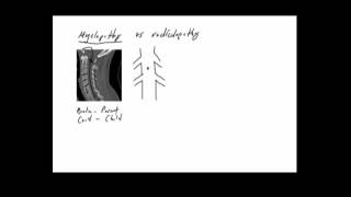 Cervical Radiculopathy  DePuy Videos [upl. by Tisbee]