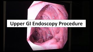 Upper GI Endoscopy Procedure in the ED [upl. by Kavita]