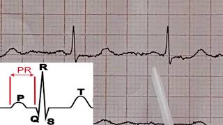 ECG Interpretation tres facile de l ECG 9eme partie Lecture d un ECG Normal [upl. by Busch]