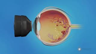 Animation of Wet and Dry Macular Degeneration [upl. by Harmony175]