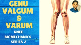 GENU VALGUM amp GENU VARUM  Knee Complex Biomechanics [upl. by Aihsenot]