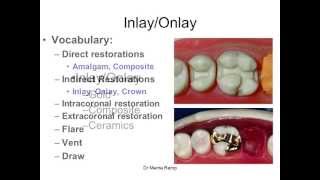 Introduction to inlaysonlays [upl. by Norat]