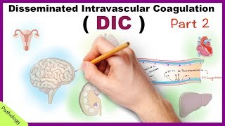 DIC Disseminated Intravascular Coagulation  Part 2 [upl. by Button]