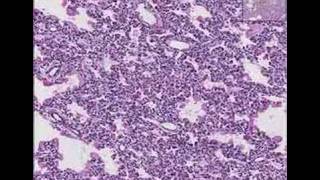 Histopathology LungHyaline membrane disease [upl. by Glarum]