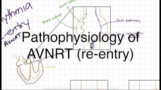 Radiofrequency Catheter Ablation of AVNRT [upl. by Anaujit268]