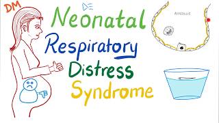 Neonatal Respiratory Distress Syndrome NRDS  Pediatrics  Pulmonology [upl. by Eckart]