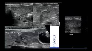 Hypertrophic Pyloric Stenosis amp Ultrasound [upl. by Flemming]