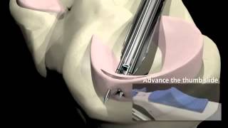 Arthroscopic Meniscus Repair [upl. by Sieracki]