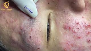 Treatment of acne tablets pustules and blackheads 360  Loan Nguyen [upl. by Hadsall]