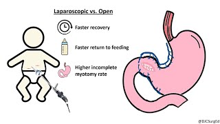 Hypertrophic Pyloric Stenosis [upl. by Haley21]